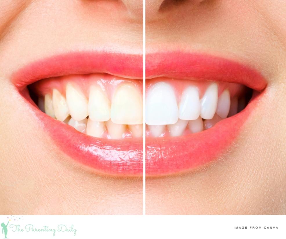 picture of before and after teeth whitening
